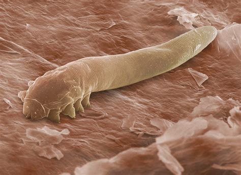 Demodex Described The Dry Eye Treatment Center