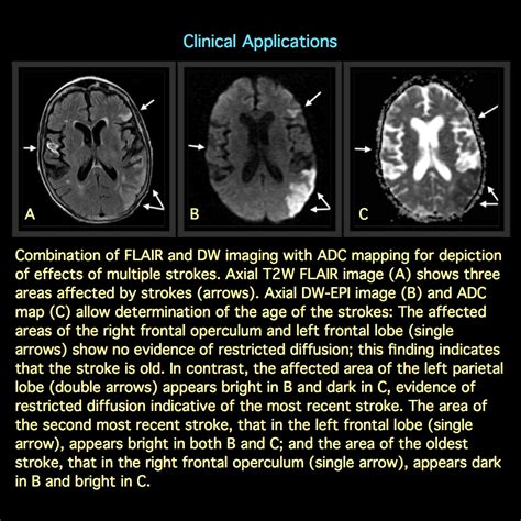 Mri Blog Diffusion Weighted Mr Imaging