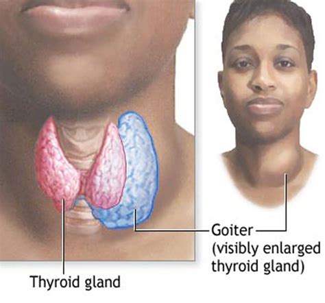 Goiter Is Caused Primarily By A Deficiency Of Daffyqws