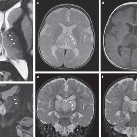 Pdf Differential Diagnosis Of Bilateral Thalamic Lesions