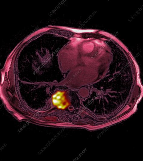 Lung Cancer Mri Stock Image C0353609 Science Photo Library