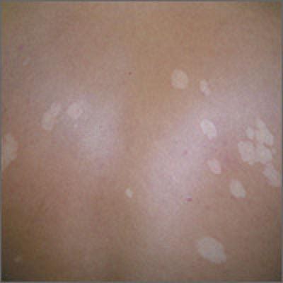 Subsequently, such formation can grow, white spots can appear on various parts of the skin, including the face. White spots on back | MDedge Family Medicine