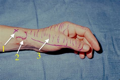 Superficial Dorsal Radial Sensory Nerve Laceration Hand Surgery Source