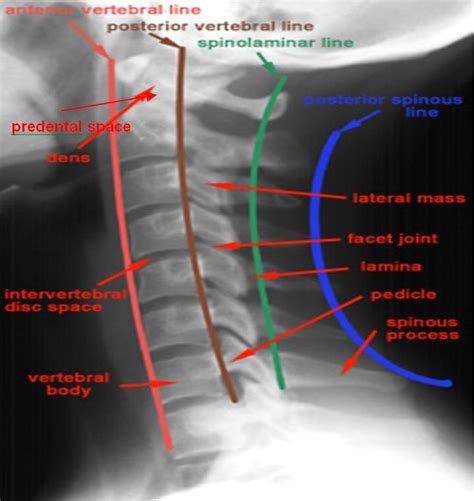 X Ray Skills 2 Cervical Spine X Ray Interpretation In 2023 Medical