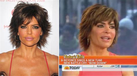 Lisa Rinna On Lip Trouble Silicone Removed After Lips Got Yucky