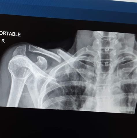 59f Broken Collarbone And Sent Home By Er In A Cast Doctor Said It