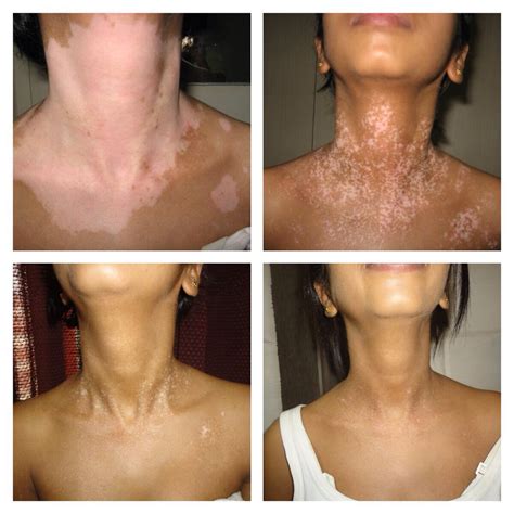 case of active vitiligo maharshi vitiligo centres india s largest vitiligo chain