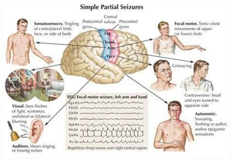 Seizures Epilepsy Symptoms Seizure Symptoms Epilepsy Facts Temporal Lobe Epilepsy Epilepsy
