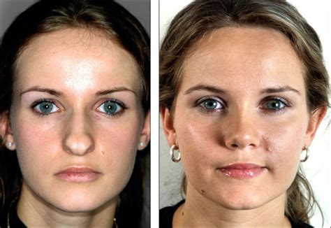 Before And After Pictures Show How A Nose Job Can Change Your Face 8 Pics