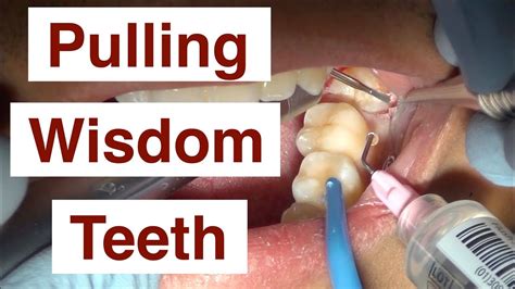 How To Remove Wisdom Tooth Without Surgery Howtoremoveb