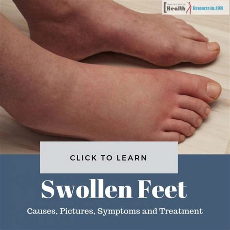 Swollen Feet Causes Pictures Symptoms And Treatment Swollen Feet