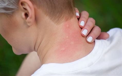 When Should You Call A Doctor About An Insect Sting Scripps Health