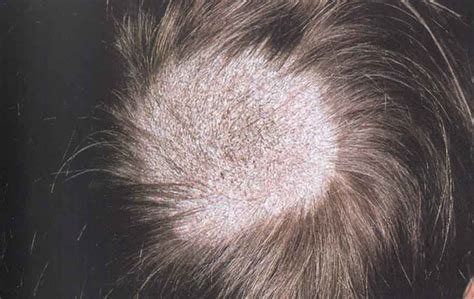 Tinea Capitis Causes Types Symptoms And Treatment