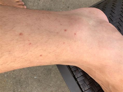 Lamictal/Lamotrigine rash - please help : r/Epilepsy