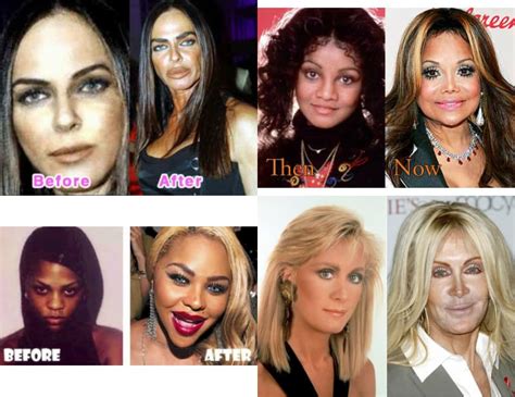 Celebrity Bad Plastic Surgery Before And After