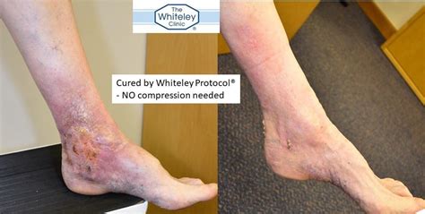 Venous Leg Ulcer Cured Without Compression The Whiteley