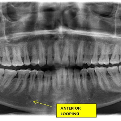The clinical impact of missed anatomy may result in failure and the necessity to carry out costly root the clinician must be aware of the complexities of the root canal system and anatomical variations of. CNN architecture for local information based probability ...