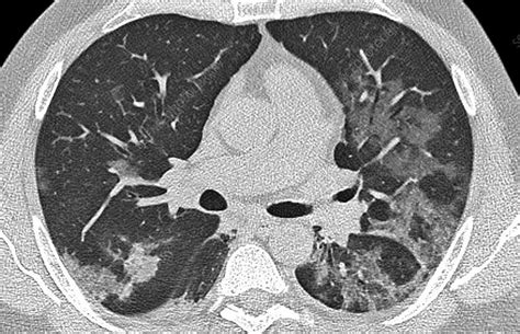 Lungs Affected By Covid 19 Pneumonia Ct Scan Stock Image C0492962