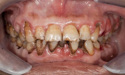 Gum Disease Incites Deadly Oral Cancer Growth The Dental Review