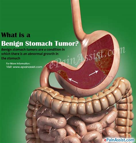 Almost 90% of cancers are adenocarciomas that symptoms of stomach cancer in the early stages largely depend on the location of the tumor. Causes of Benign Stomach Tumors: Its Symptoms and Treatment