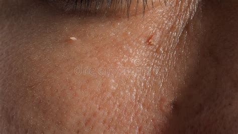 Wart Skin Removal Macro Shot Of Warts Near Eye On Face Stock Photo