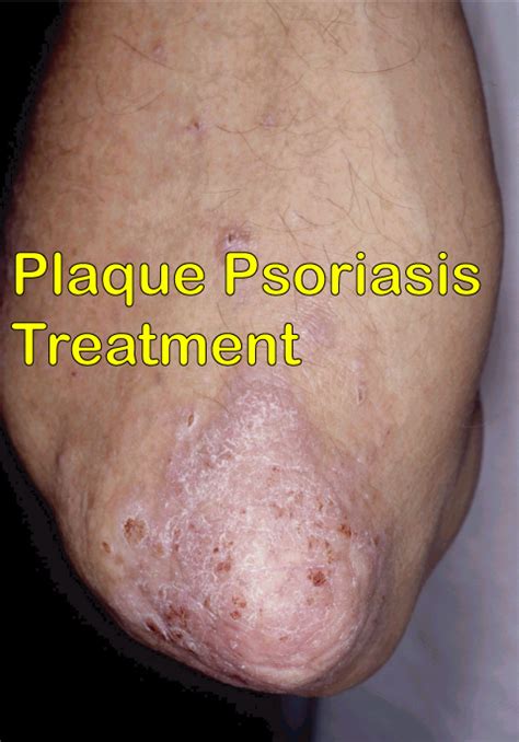 5 Best Plaque Psoriasis Treatment You Can Rely On Disfreeskin
