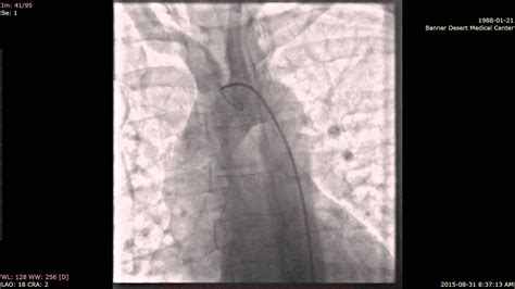 Cardiac Catheterizationangiogram Youtube