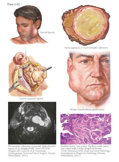 Benign Tumors Of Salivary Glands Pediagenosis