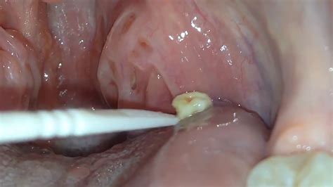 Digging Out A Large Smelly Tonsil Stone Youtube
