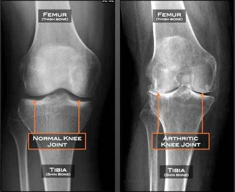 What Is Osteoarthritis Oa Of The Knee Complete Physio
