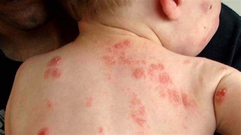 Early Exposure To Bacteria Could Prevent Eczema Abc News