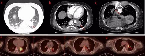 A Chest Ct Revealed A Mass In The Posterior Basal Segment Of The Left