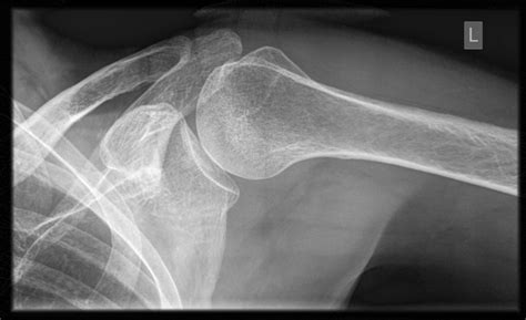 The Approach To Shoulder Radiographs — Taming The Sru