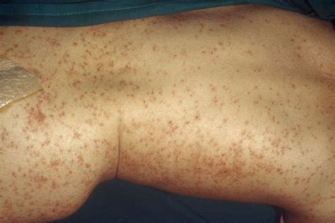 derm dx a diffuse erythematous rash that blanches with pressure clinical advisor