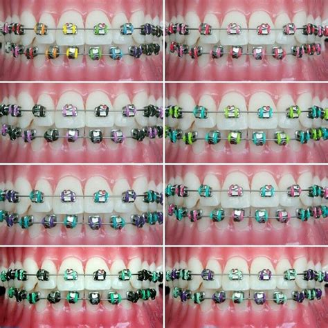 Pin By Veena Lewgorne On Braces Colors Orthodontics Braces Cute