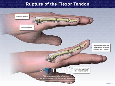 Rupture Of The Flexor Tendon Trialexhibits Inc