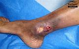 Photos of Best Treatment For Venous Stasis Ulcers