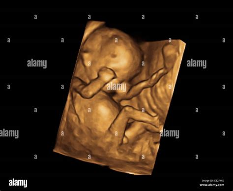 Coloured 3 D Ultrasound Scan Of A Foetus Gestational Age 12 Weeks