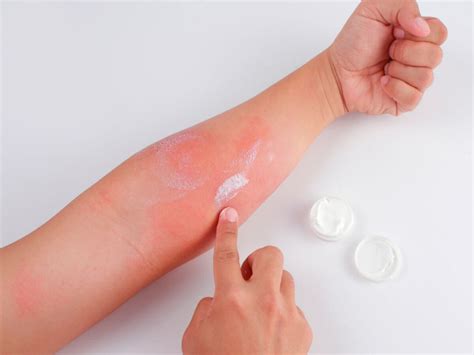 Los 4 Tipos De Dermatitis Y Sus Características