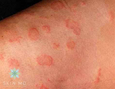 What Does A Skin Fungal Rash Look Like Continental Clinic