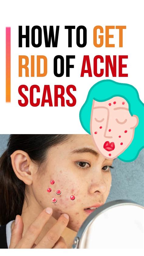 How To Get Rid Of Acne Scars Artofit