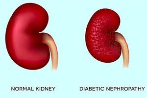Diabetic Kidney Disease Overview