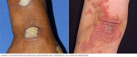 Psoriasis Symptoms And Causes Mayo Clinic