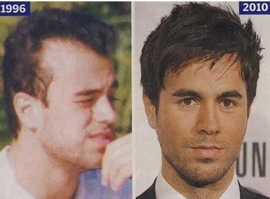 Chatter Busy Enrique Iglesias Hair Transplant
