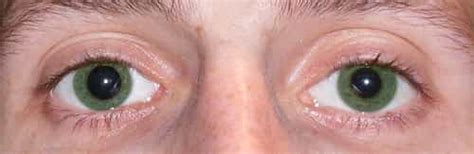 Anisocoria Causes Symptoms And Related Treatment