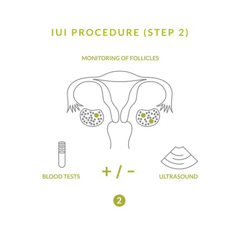 Intrauterine Insemination Iui British Columbia Olive Fertility Centre