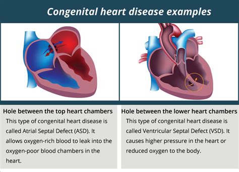 Congenital Heart Defects In Children Types Causes Sym