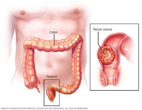 Rectal Cancer Symptoms And Causes Mayo Clinic