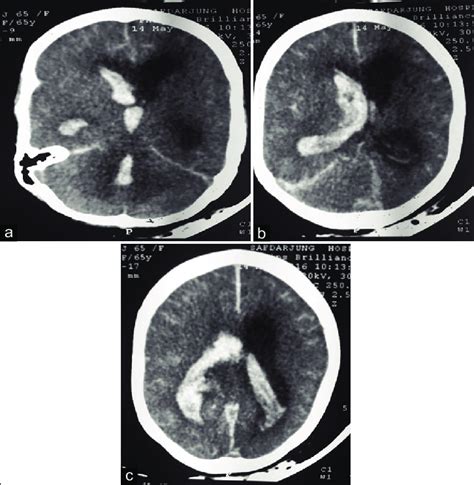A C Noncontrast Computed Tomography Of Head Dilated Bilateral