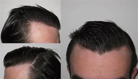 Hair Solutions Dralan Feller 800 Grafts Class 2 Fue Male